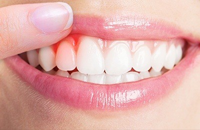 Homeopathy Medicine for Mouth, Gums & Teeth